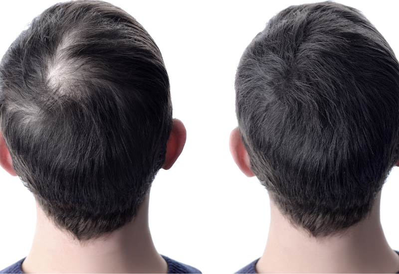 Nang tóc được kích thích sản sinh collagen, cung cấp dưỡng chất cho da đầu